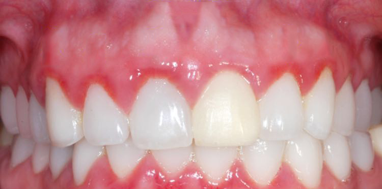 dientes con enfermedad periodontal gingivitis